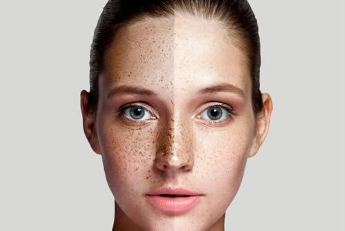 Understanding Melasma and How To Treat It?