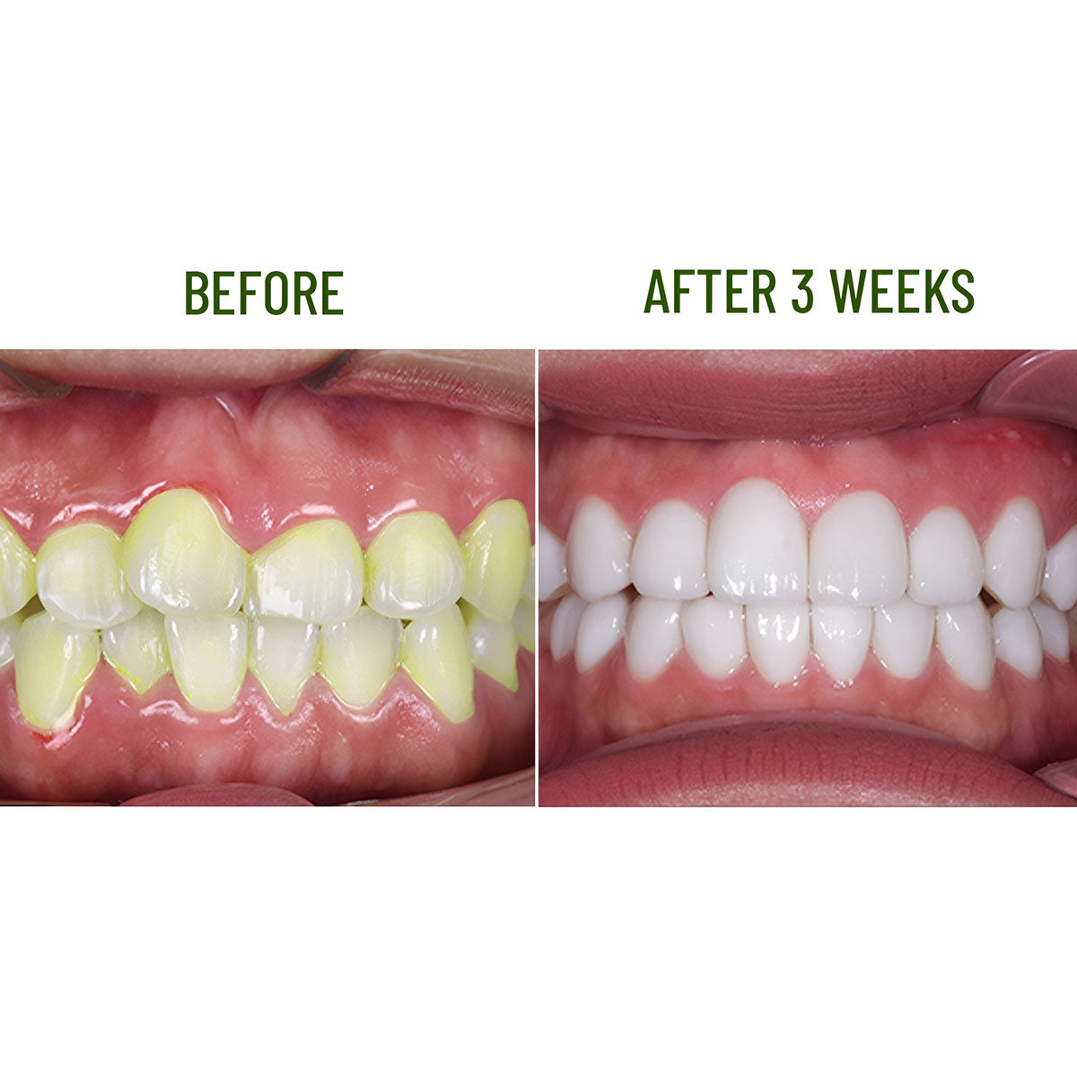 Teeth Whitening Enamel Kagami Abera Green Coffee - FREE GIFT Teeth Whitening Strips- KI