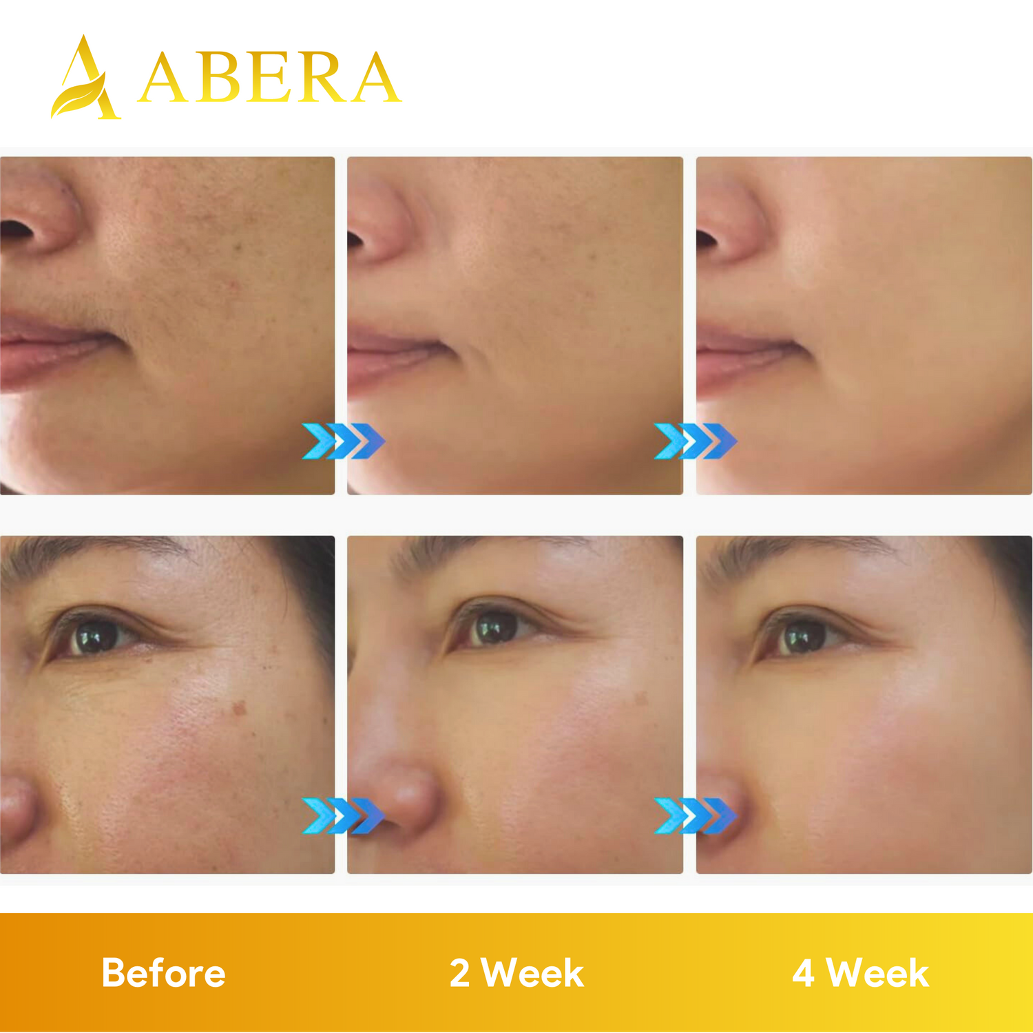 ABERA Melasma Serum, Dark Spot Corrector Serumwith Niacinamide and Hyaluronic Acid, Melasma Treatment for Face (AMZ)