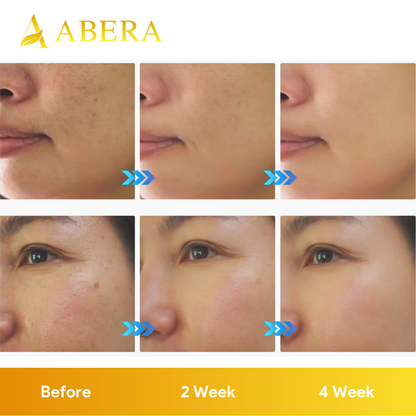 Abera Melasma Pigmentation Treatment for Face - CS