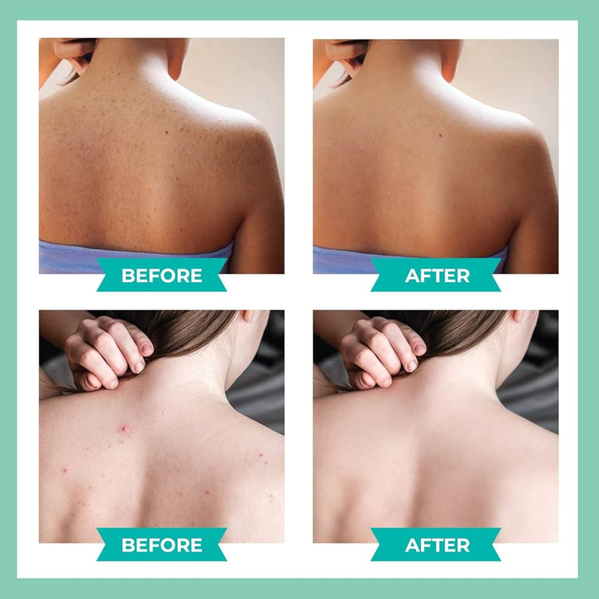 Abera BHA Back Acne Spray
