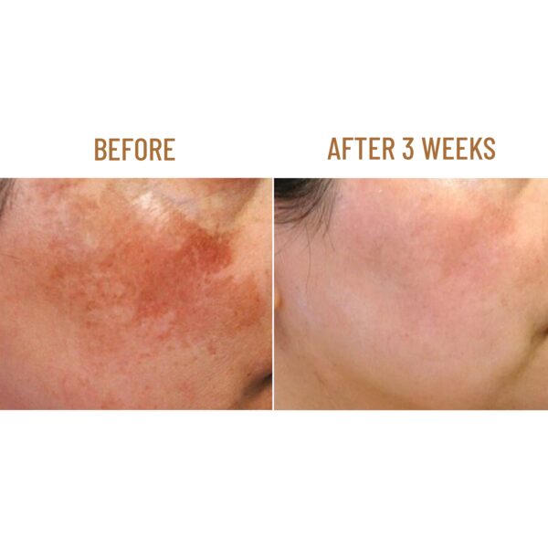 [SALE OFF 50%] Kasumi Abera Cream - GIFT Derma Skin Roller