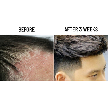 Scalp Hero  - Stimulates hair growth, moisturizes, protects the scalp, and treats dandruff.