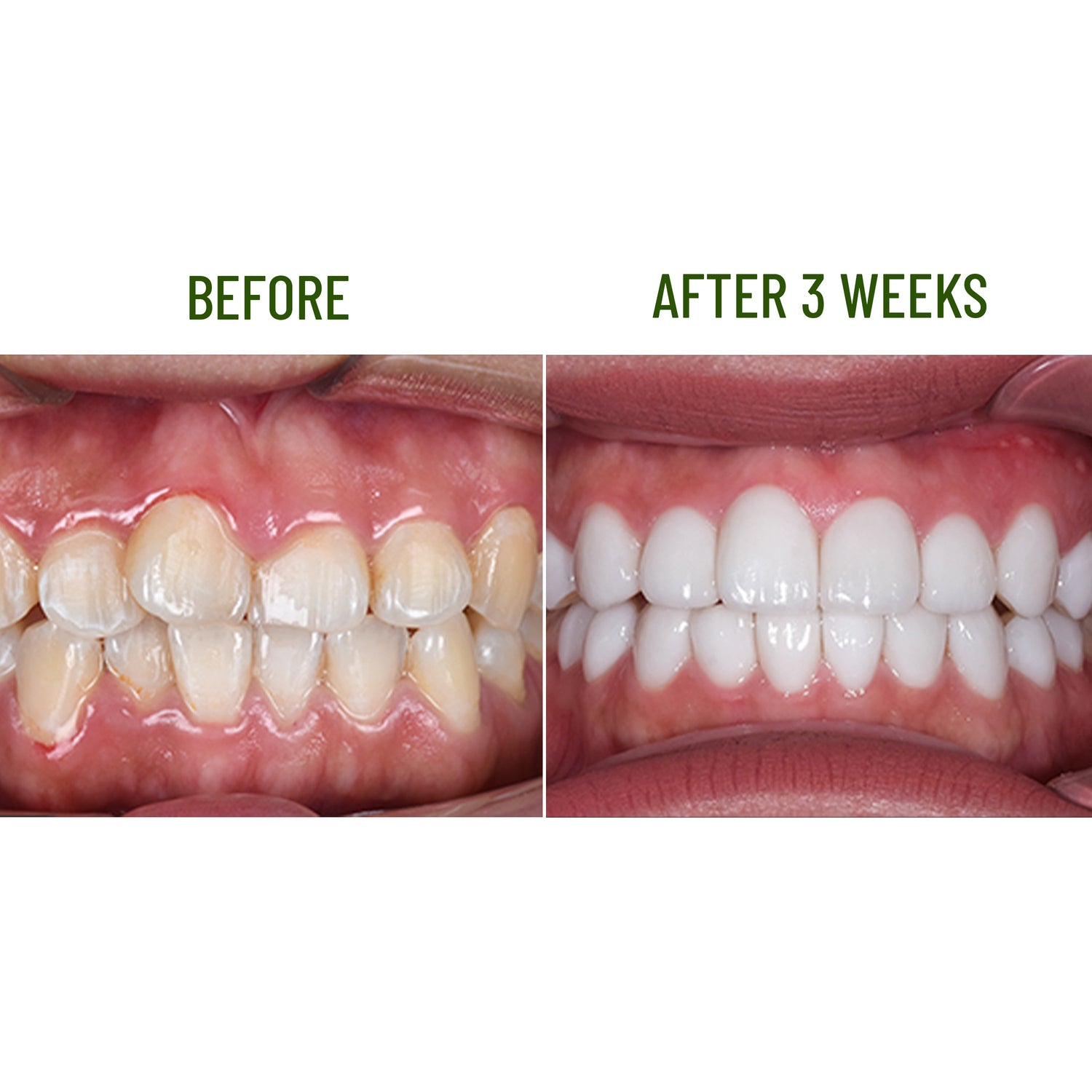 Teeth Whitening Enamel Kagami Abera Green Coffee - FREE GIFT Teeth Whitening Strips- CS