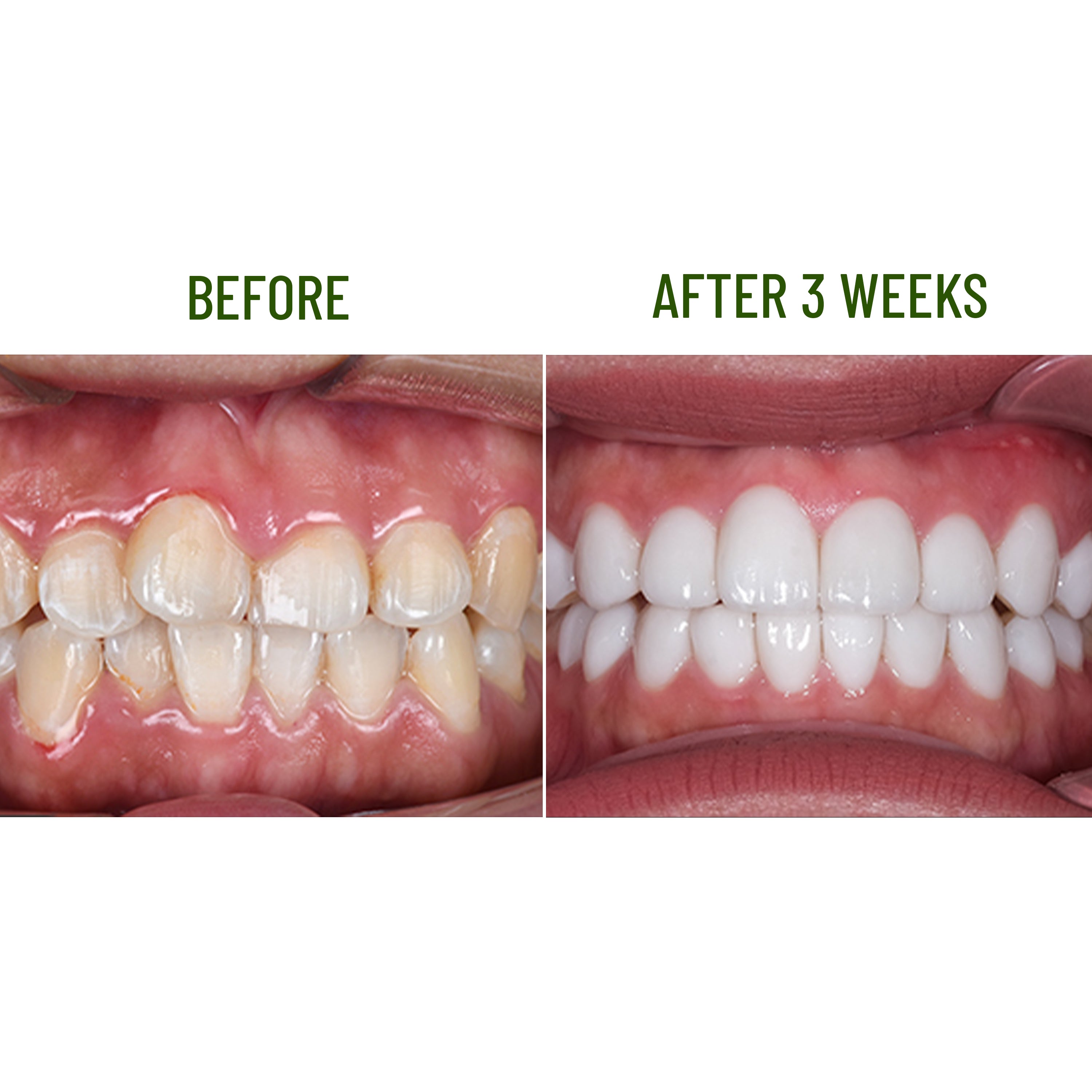 Teeth Whitening Enamel Kagami Abera - DI